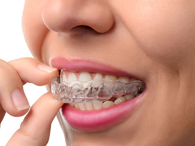 West Islip Orthodontics | Mouthguards, Two-Phase Treatment and Adult Orthodontics