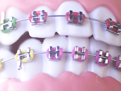 West Islip Orthodontics | Orthodontics for Children, Two-Phase Treatment and Sleep Apnea